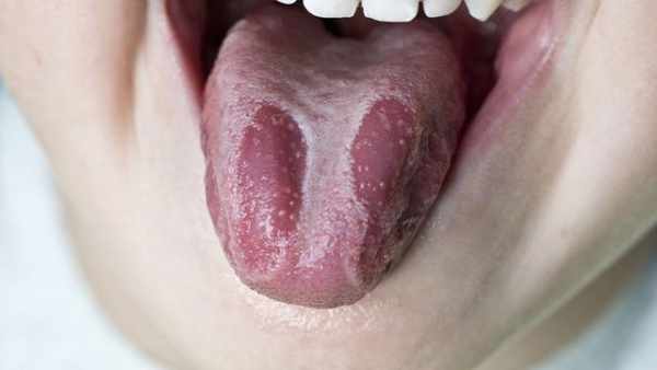 7 Obat Tradisiional untuk Menangani Infeksi Jamur pada Mulut